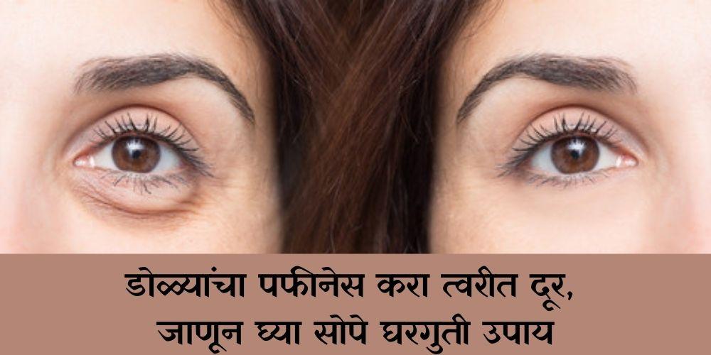 home remedies for eye puffiness