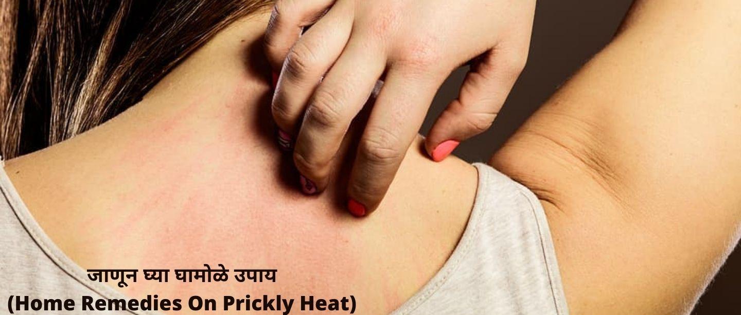 उन्हाळ्यात येणाऱ्या घामोळ्या उपाय (Home Remedies On Prickly Heat)