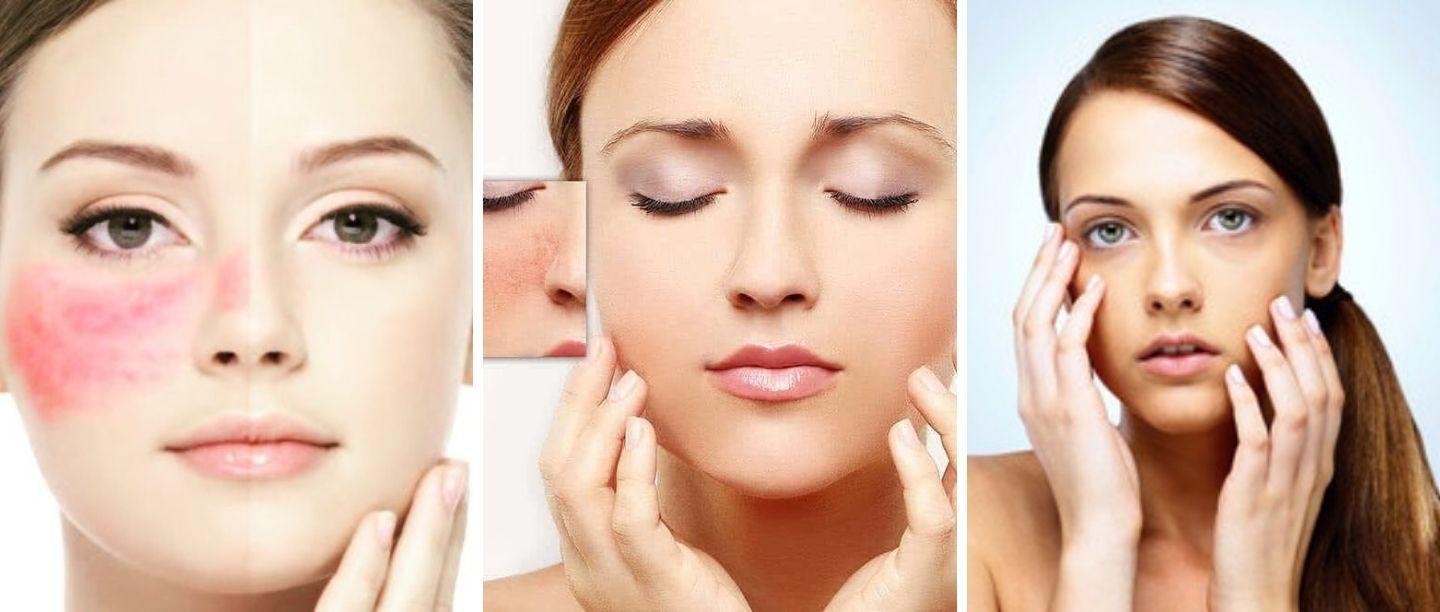 How To Reduce Redness On Face In Marathi