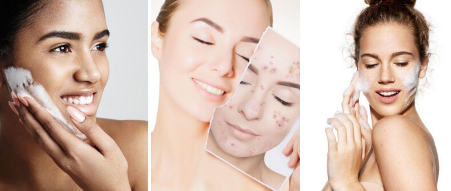 कोरड्यचेहऱ्यावर असतील मुरूमं, तर नक्की ट्राय करा ‘हे’ फेस वॉश (Best Face Wash For Pimples)