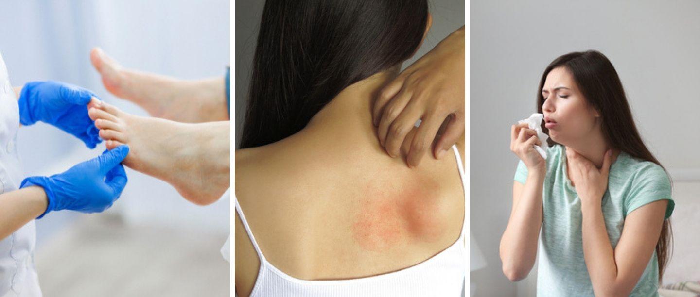 पावसाळ्यातील त्वचेच्या समस्या, अलर्जी आणि त्याची काळजी