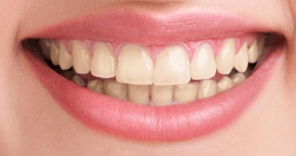 पिवळ्या दातांनी हैराण असलात तर करा 8 घरगुती उपाय
