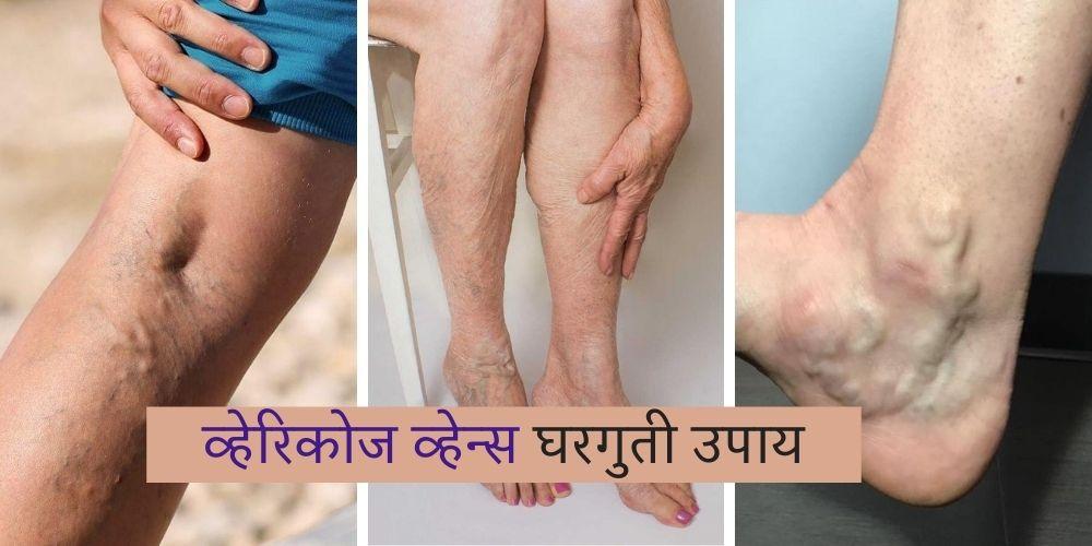 varicose veins home remedies in marathi
