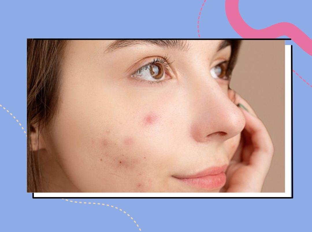 how-to-deal-with-menstrual-acne